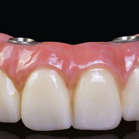 All-on-4 Dental Laboratory in Fort 